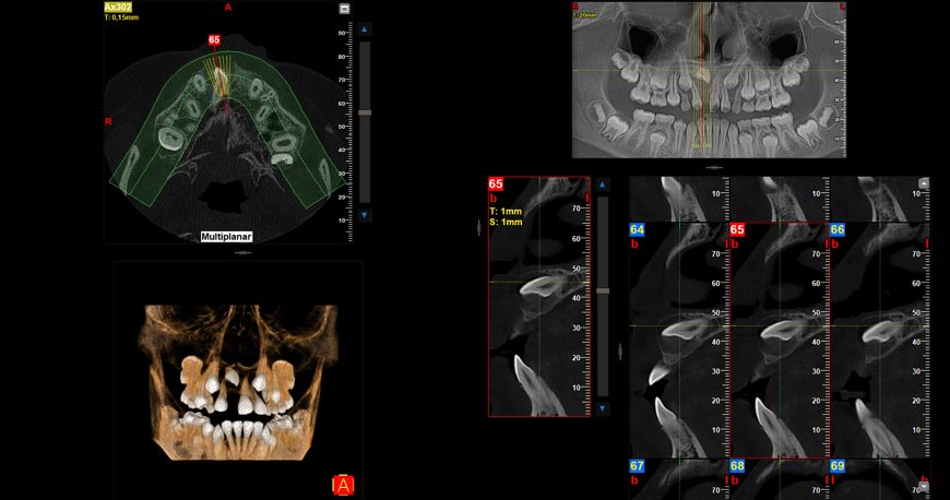 Fig 5. Cortes en ventana MPR y renderizado 3D