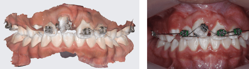 Fig 24 y 25. Fotografía escaneo intraoral junto a técnica de doble arco con doblez de extrusión. Después de colocar el incisivo 1.1 en el arco dental, para su alinea