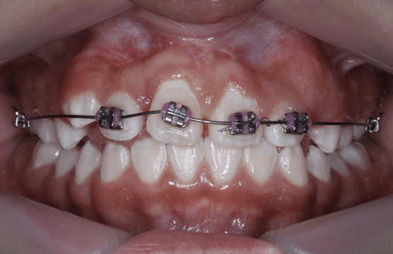 Fig 26. Fotografía de arco 0.018 niti para alineación dental