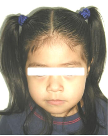 Fig. 1 Facial de frente