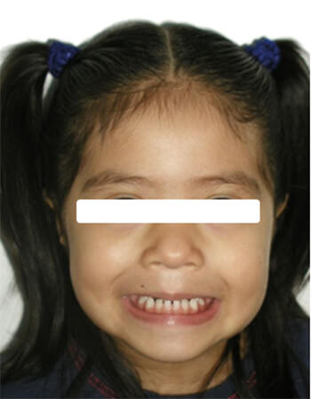 Fig. 2 Facial de sonrisa