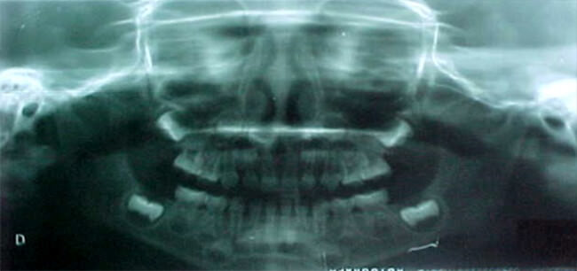 Figura 4 Rx Panorámica