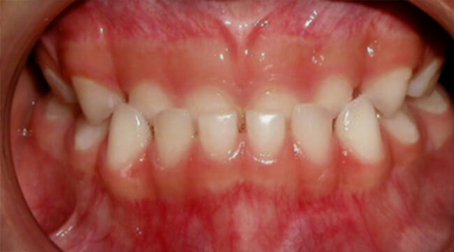 Fig. 5 Intraoral de frente