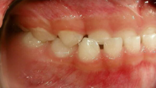 Fig 6 Intraoral derecha