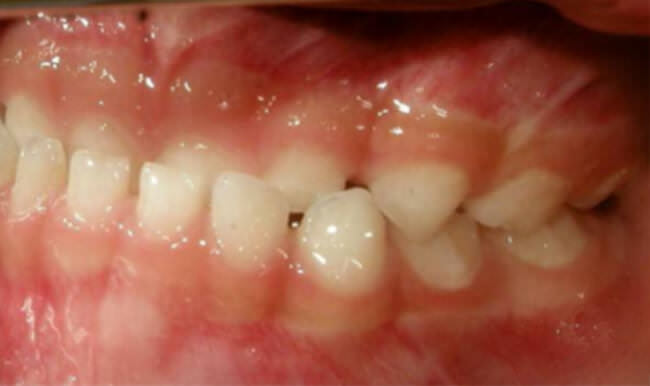 Fig 7 Intraoral izquierda