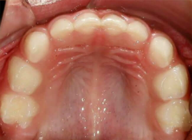 Fig 8 Intraoral