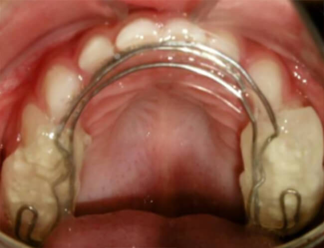 Fig 10. Arco superior en w modificado