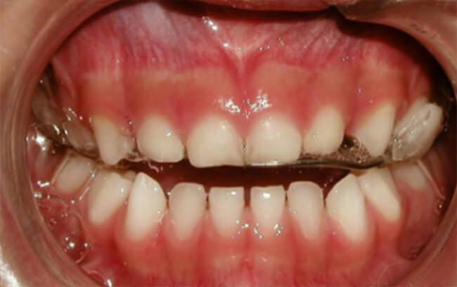 Fig 11. Intraoral de frente