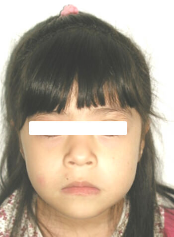 Fig 12. Facial de frente