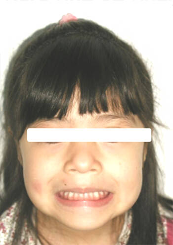 Fig 13. Facial de sonrisa