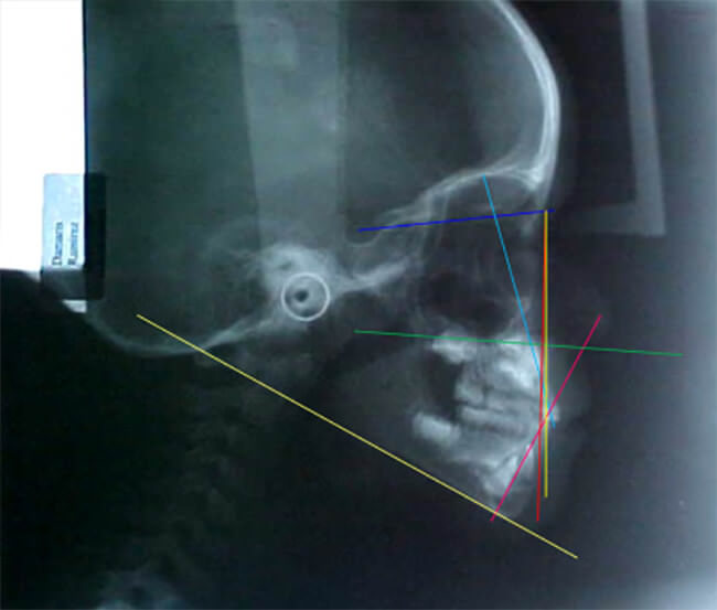 Fig 14. Radiografia lateral de craneo