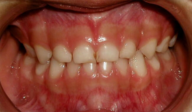 Fig 15. Intraoral de frente