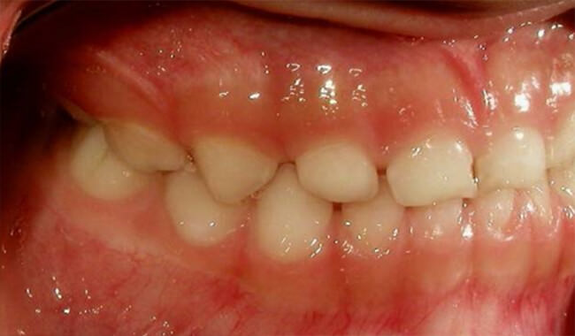 Fig 16. Intraoral derecha