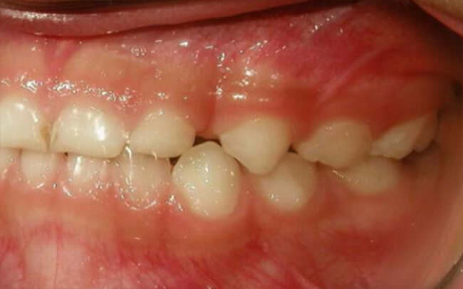 Fig 17. Intraoral izquierda