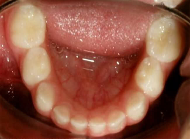 Fig 19. Intraoral inferior