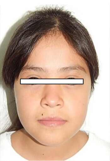 Fig 20. Faciales de frente