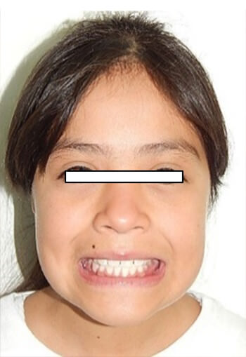 Fig 21. Facial de sonrisa.
