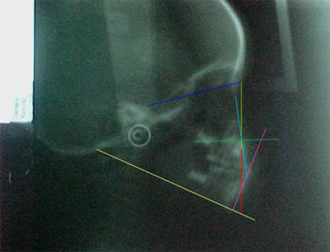 Fig. 21 Rx. de inicio