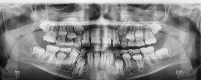 Fig. 23 Radiografía panorámica