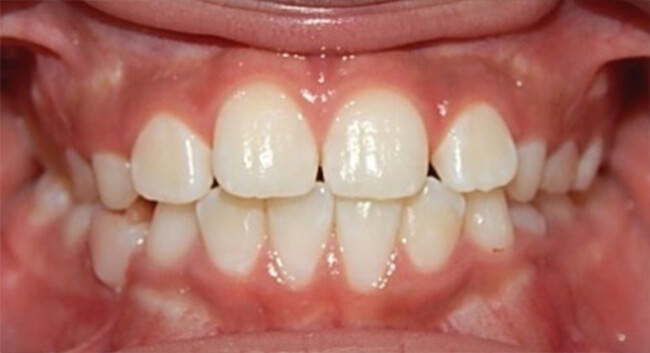 Fig 24 Intraoral de frente