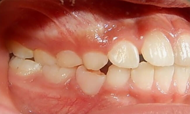 Fig 25 Lateral derecha
