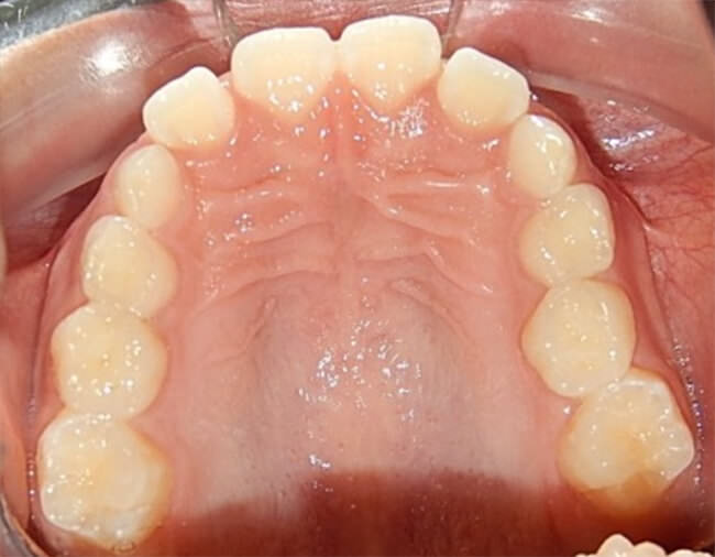Fig 27. Intraoral superior