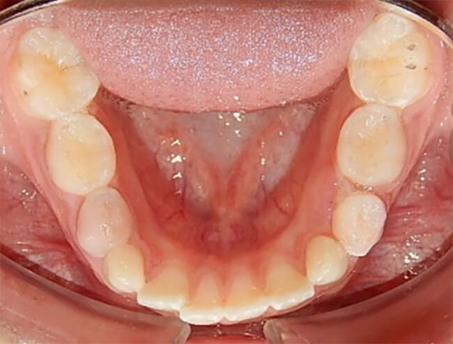 Fig 28. Intraoral inferior post retención
