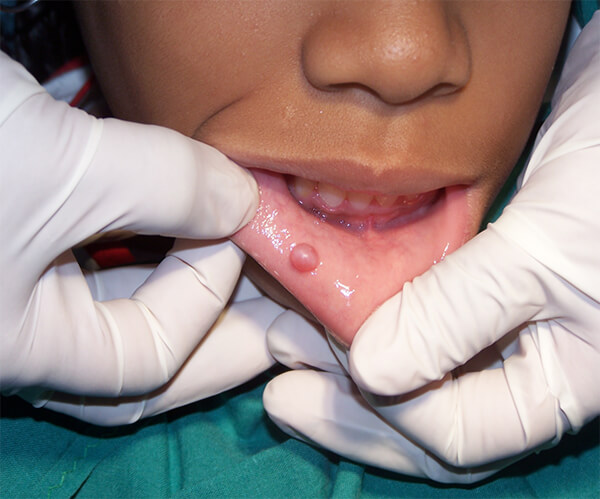 Foto Nro. 1. Mucocele (Fuente propia)