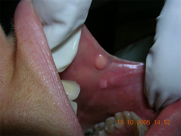 Foto Nro. 2. Fibroma Traumático (Fuente propia)