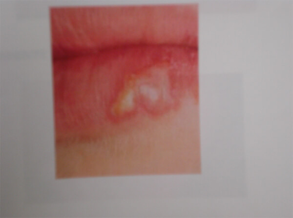 Foto Nro. 3. Virus Herpes Tipo I (Fuente propia)