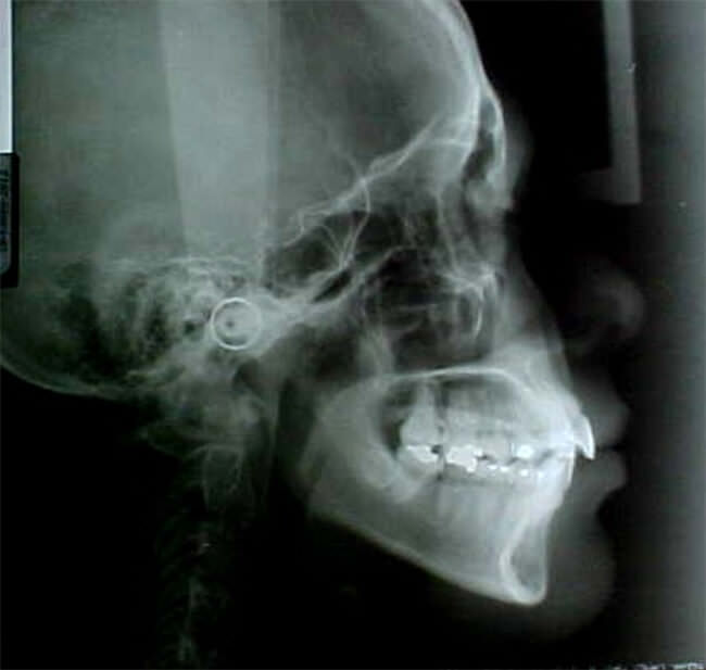 Fig. 1 Radiografía lateral de cráneo