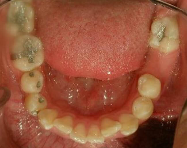 Fig.8 Oclusal inferior