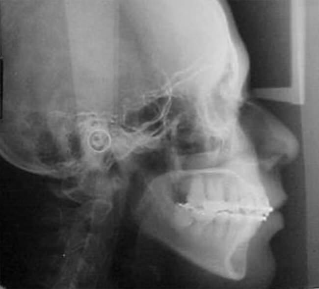 Fig. 9 Rx. lateral de cráneo