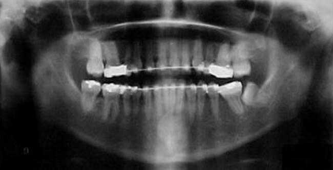 Fig.10 Rx Panorámica