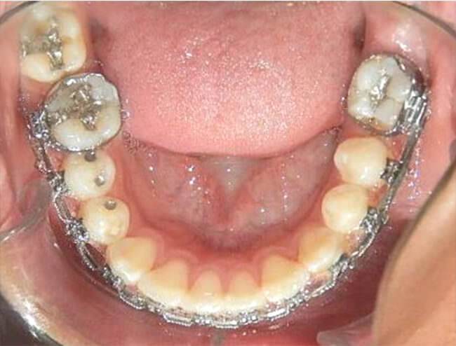 Fig. 12 Mecánica mesialización vista oclusal