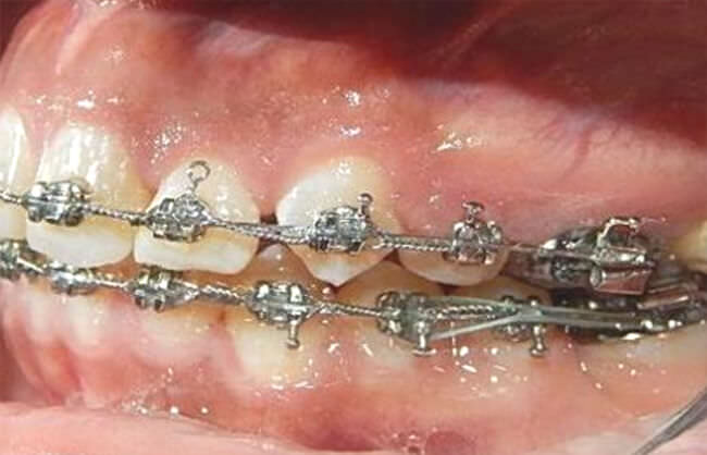 Fig. 13 Mesialización izquierda