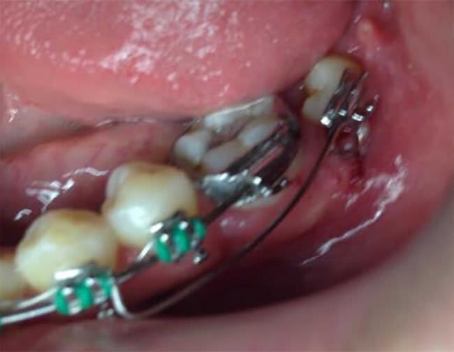Fig. 14 Mecánica de verticalización