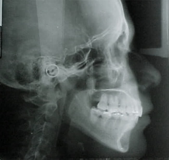 Fig.16 Rx lateral de cráneo