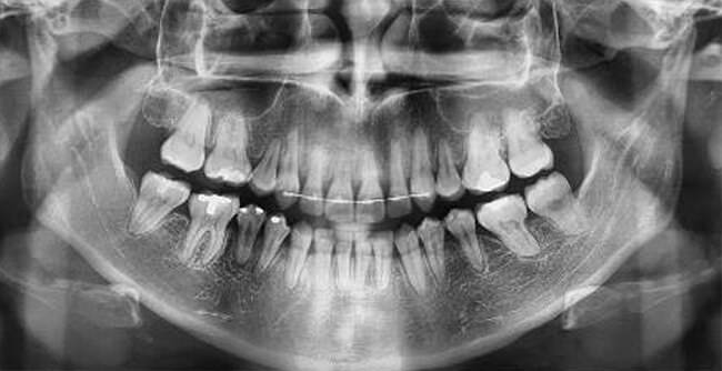 Fig. 17 Rx panorámica