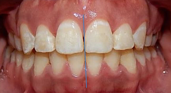 Fig.19 Intraoral Frente