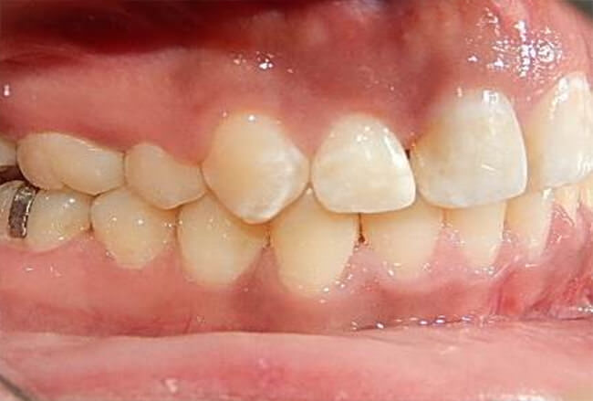 Fig. 18 Intraoral derecha