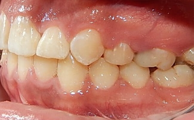 Fig.18 Intraoral izquierda