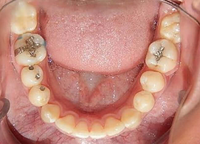 Fig. 21 Oclusal inferior