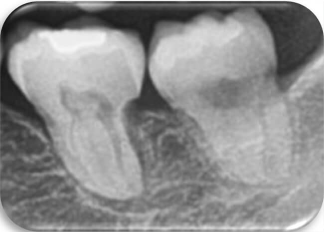 Fig.22 Radiografía Inicio, progreso y final.