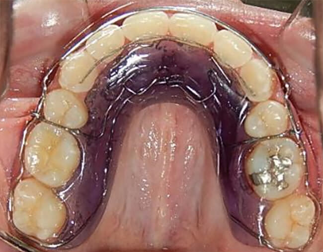 Fig. 24 Retenedor superior