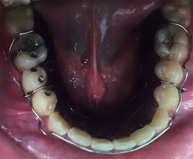 Fig.25 Retenedor inferior