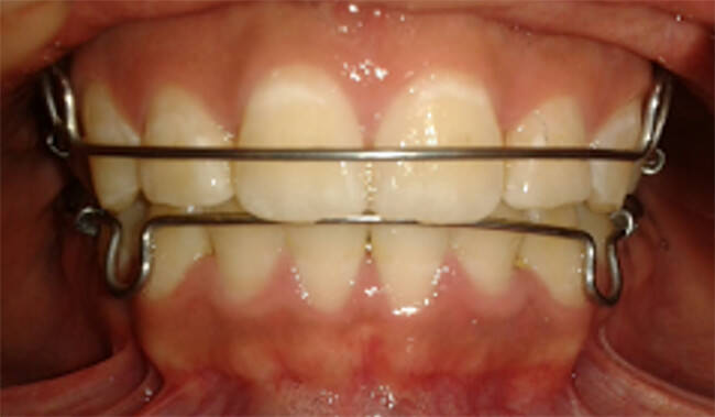 Fig. 26 Intraoral de frente con retenedores