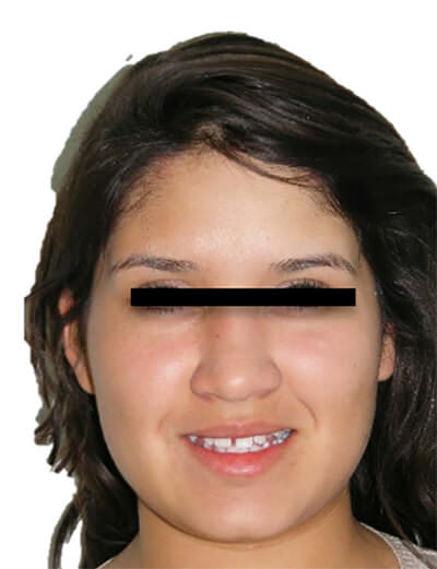 Fig. 3 Sonrisa