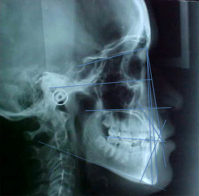 Fig. 9 Radiografía con el trazado inicial cefalométrico