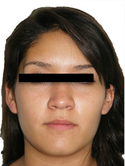 Fig. 11 Frente progreso